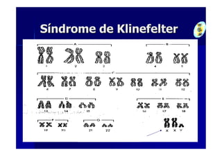 Síndrome de Klinefelter
 