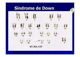 Síndrome de Down
 