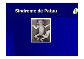 Síndrome de Patau
 