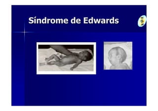 Síndrome de Edwards
 