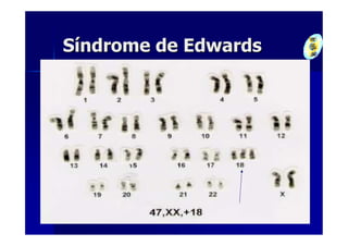 Síndrome de Edwards
 