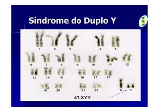 Síndrome do Duplo Y
 