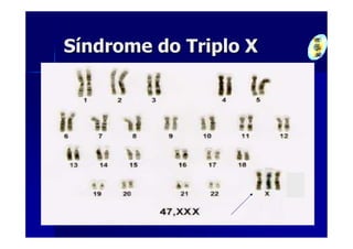 Síndrome do Triplo X
 