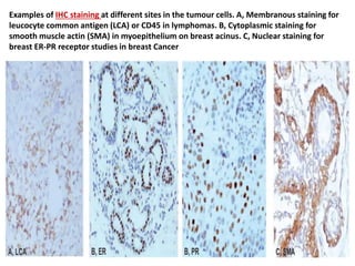 lab diagnosis of neoplasm or tumours | PPTX