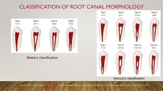 Weine’s classification
Vertucci's classification
Vertucci FJ. Root canal morphology and its relationship to endodontic procedures. Endodontic topics. 2005 Mar;10(1):3-29.
 