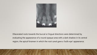 Dilacerated roots towards the buccal or lingual directions were determined by
evaluating the appearance of a round opaque area with a dark shadow in its central
region, the apical foramen in which the root canal gave a 'bulls-eye' appearance.
 