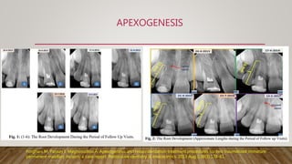 APEXOGENESIS
Forghani M, Parisay I, Maghsoudlou A. Apexogenesis and revascularization treatment procedures for two traumatized immature
permanent maxillary incisors: a case report. Restorative dentistry & endodontics. 2013 Aug 1;38(3):178-81.
 