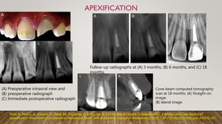 Cone-beam computed tomography
scan at 18 months. (A) Straight-on
image;
(B) lateral image
Follow-up radiographs at (A) 3 months, (B) 6 months, and (C) 18
months.
c
(A) Preoperative intraoral view and
(B) preoperative radiograph
(C) Immediate postoperative radiograph
Vidal, K., Martin, G., Lozano, O., Salas, M., Trigueros, J., & Aguilar, G. (2016). Apical Closure in Apexification: A Review and Case Report of
Apexification Treatment of an Immature Permanent Tooth with Biodentine. Journal of Endodontics, 42(5), 730–734. doi:10.1016/j.joen.2016.02.007
 