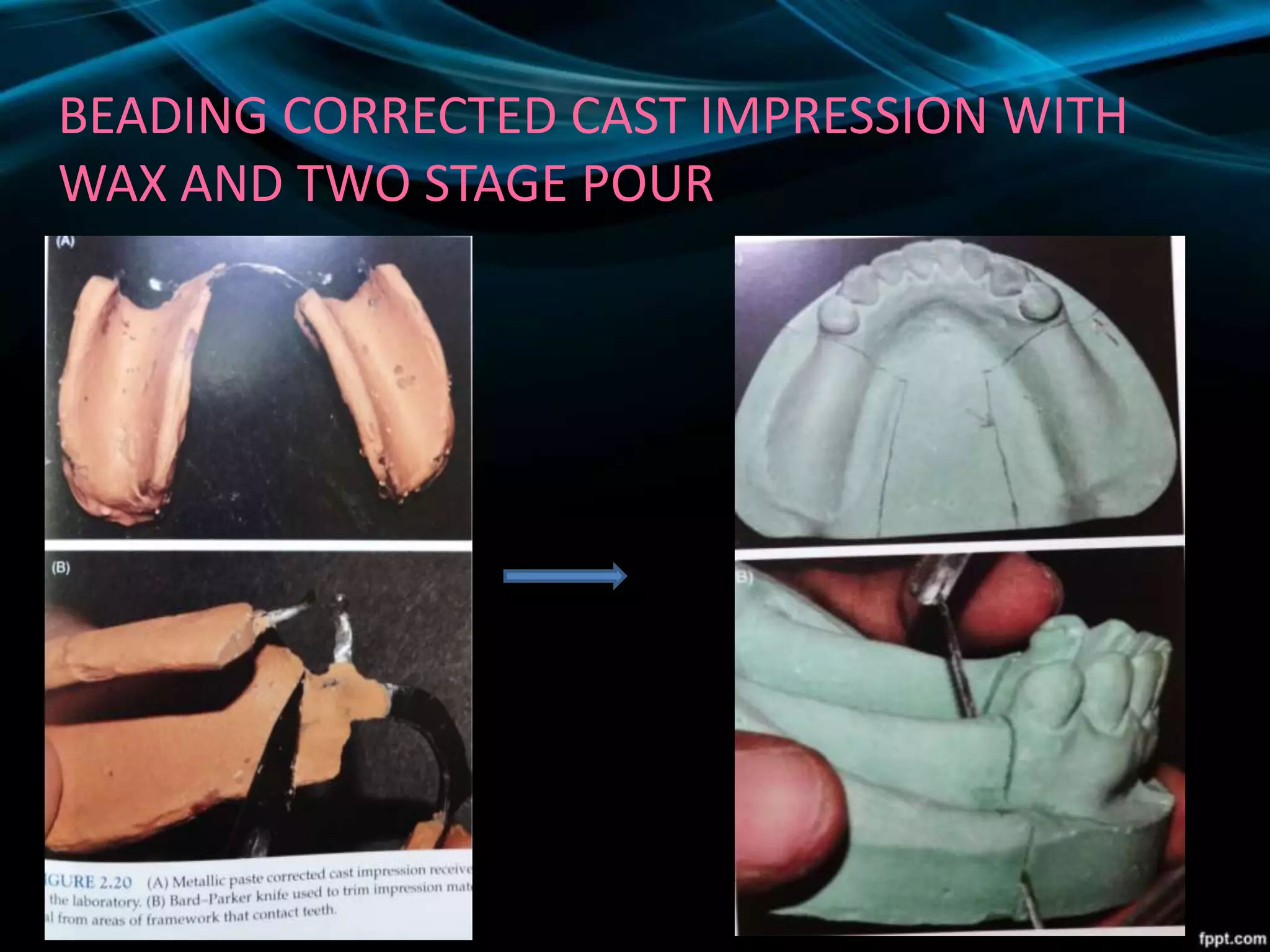 BEADING CORRECTED CAST IMPRESSION WITH
WAX AND TWO STAGE POUR
 