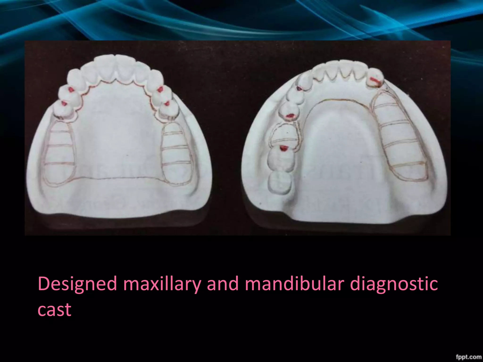 Designed maxillary and mandibular diagnostic
cast
 