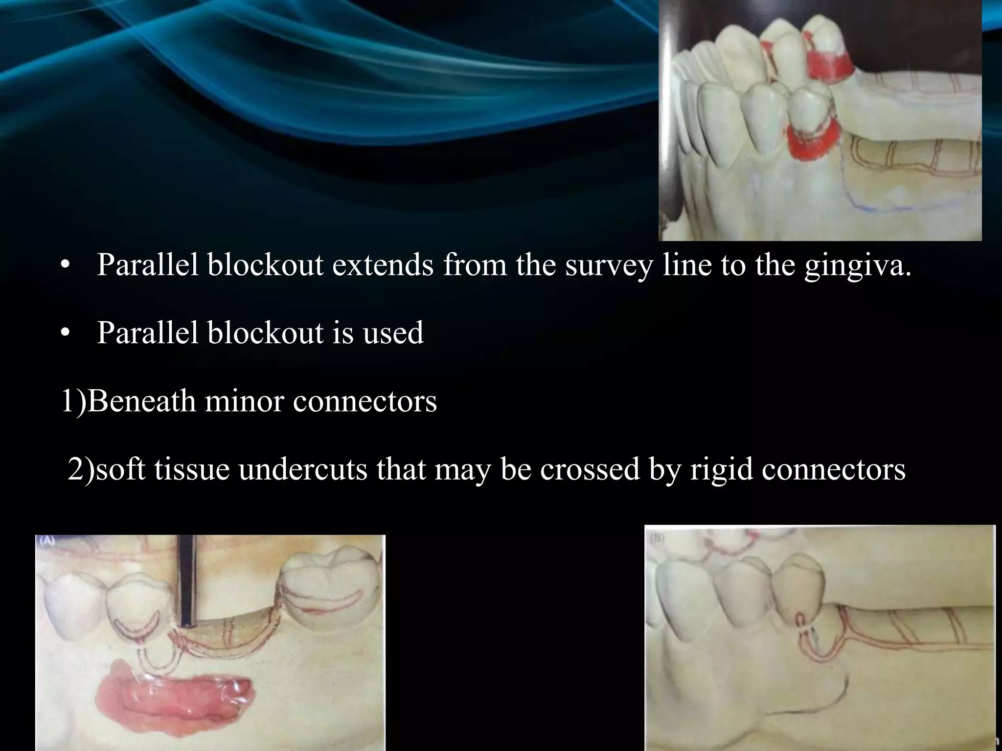 • Parallel blockout extends from the survey line to the gingiva.
• Parallel blockout is used
1)Beneath minor connectors
2)soft tissue undercuts that may be crossed by rigid connectors
 
