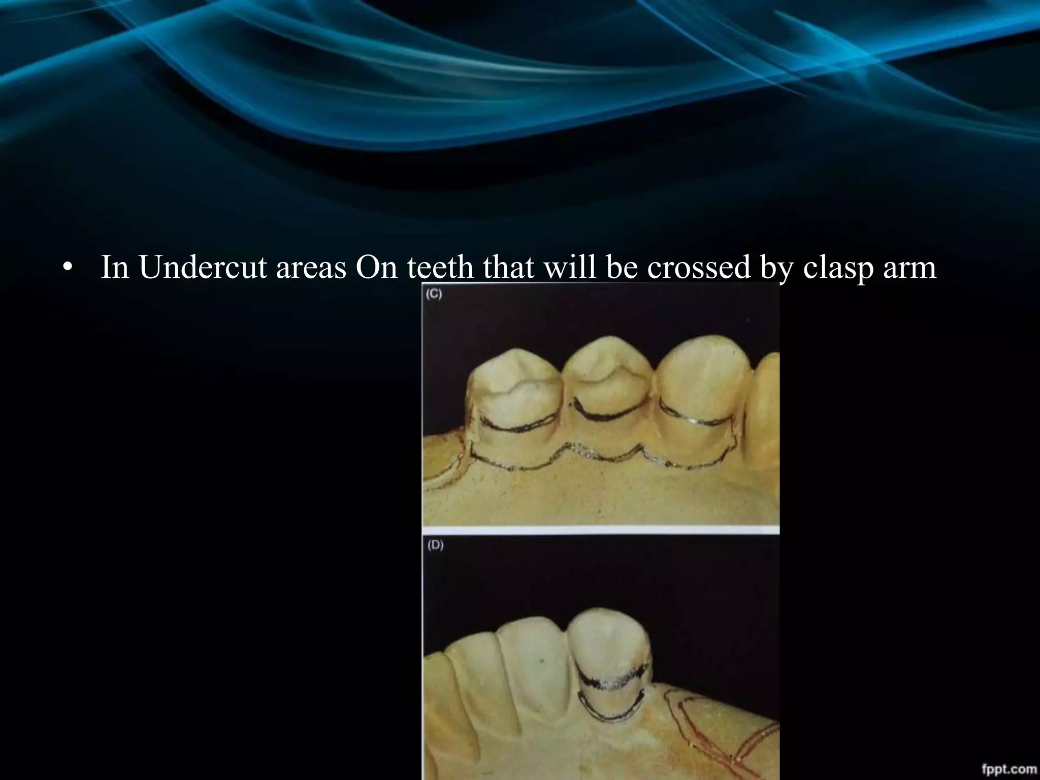 • In Undercut areas On teeth that will be crossed by clasp arm
 