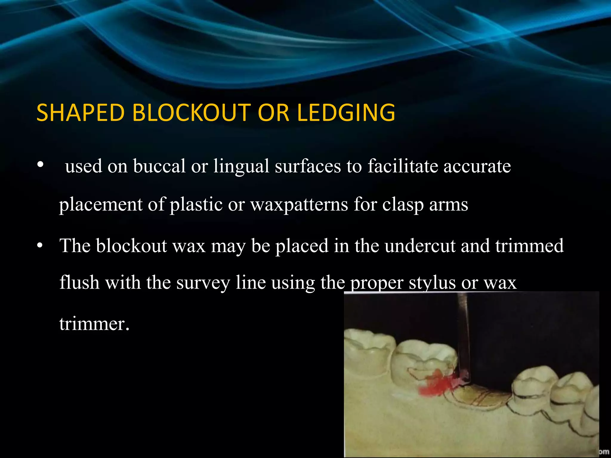 SHAPED BLOCKOUT OR LEDGING
• used on buccal or lingual surfaces to facilitate accurate
placement of plastic or waxpatterns for clasp arms
• The blockout wax may be placed in the undercut and trimmed
flush with the survey line using the proper stylus or wax
trimmer.
 