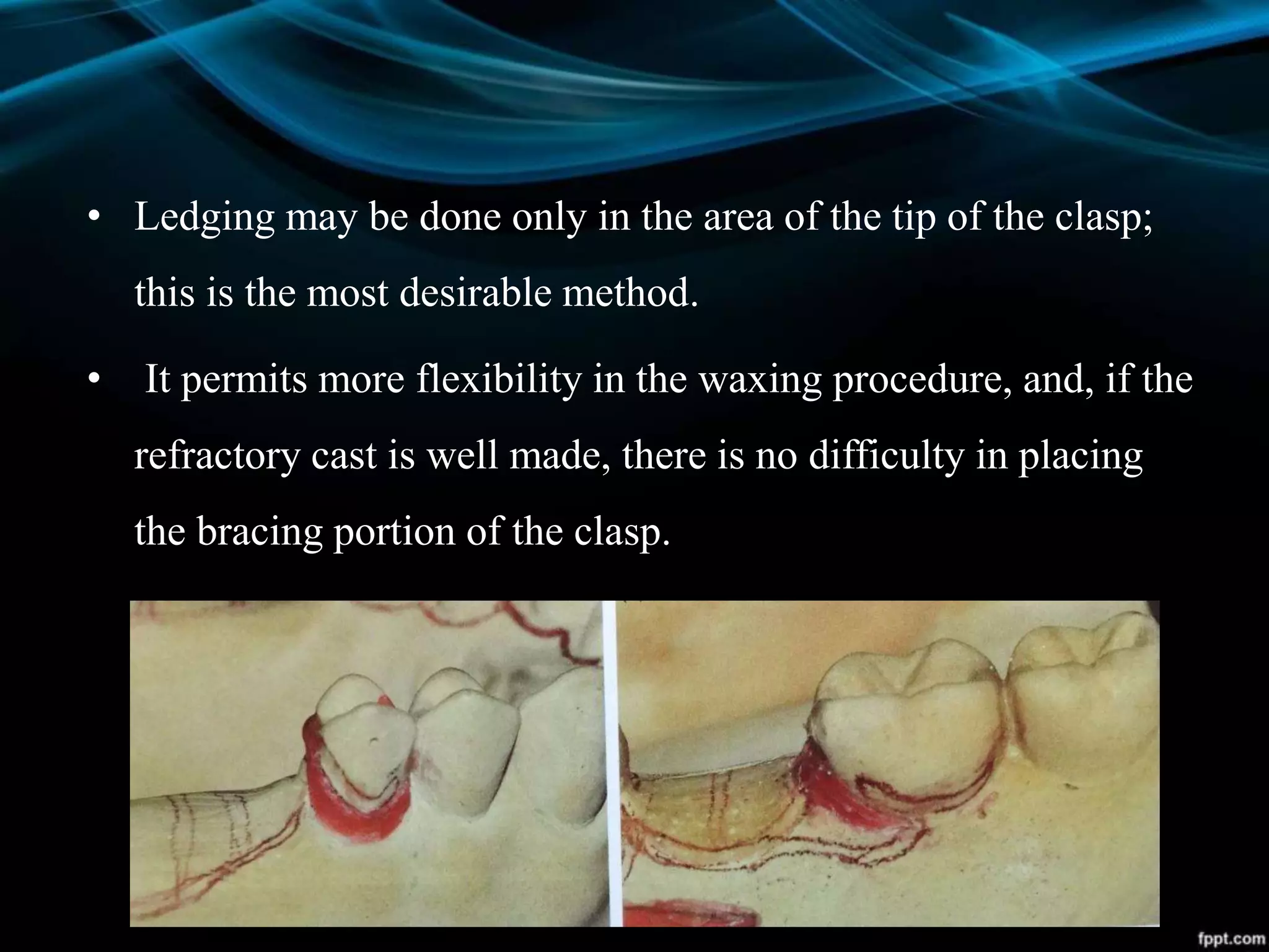 • Ledging may be done only in the area of the tip of the clasp;
this is the most desirable method.
• It permits more flexibility in the waxing procedure, and, if the
refractory cast is well made, there is no difficulty in placing
the bracing portion of the clasp.
 