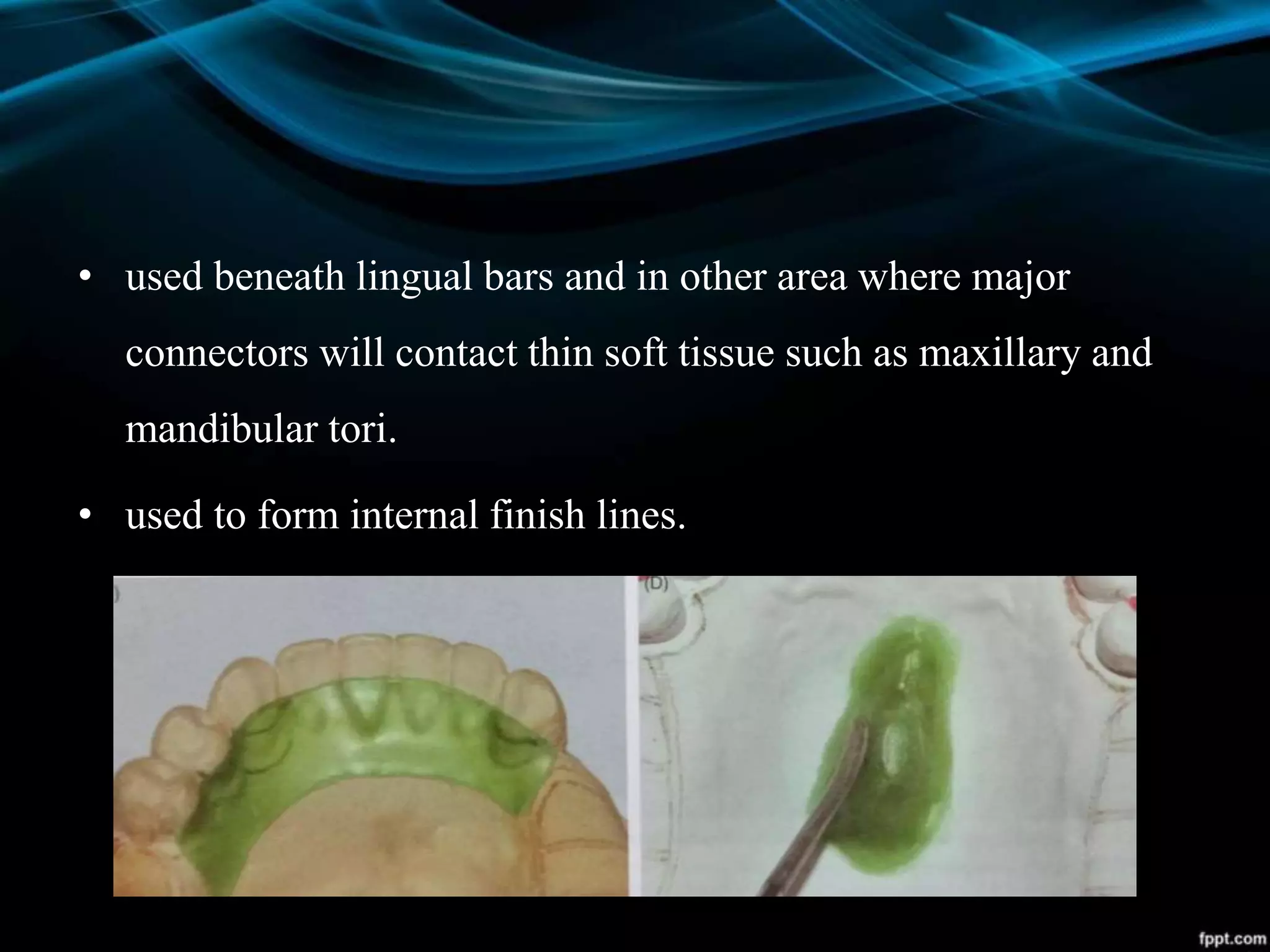 • used beneath lingual bars and in other area where major
connectors will contact thin soft tissue such as maxillary and
mandibular tori.
• used to form internal finish lines.
 