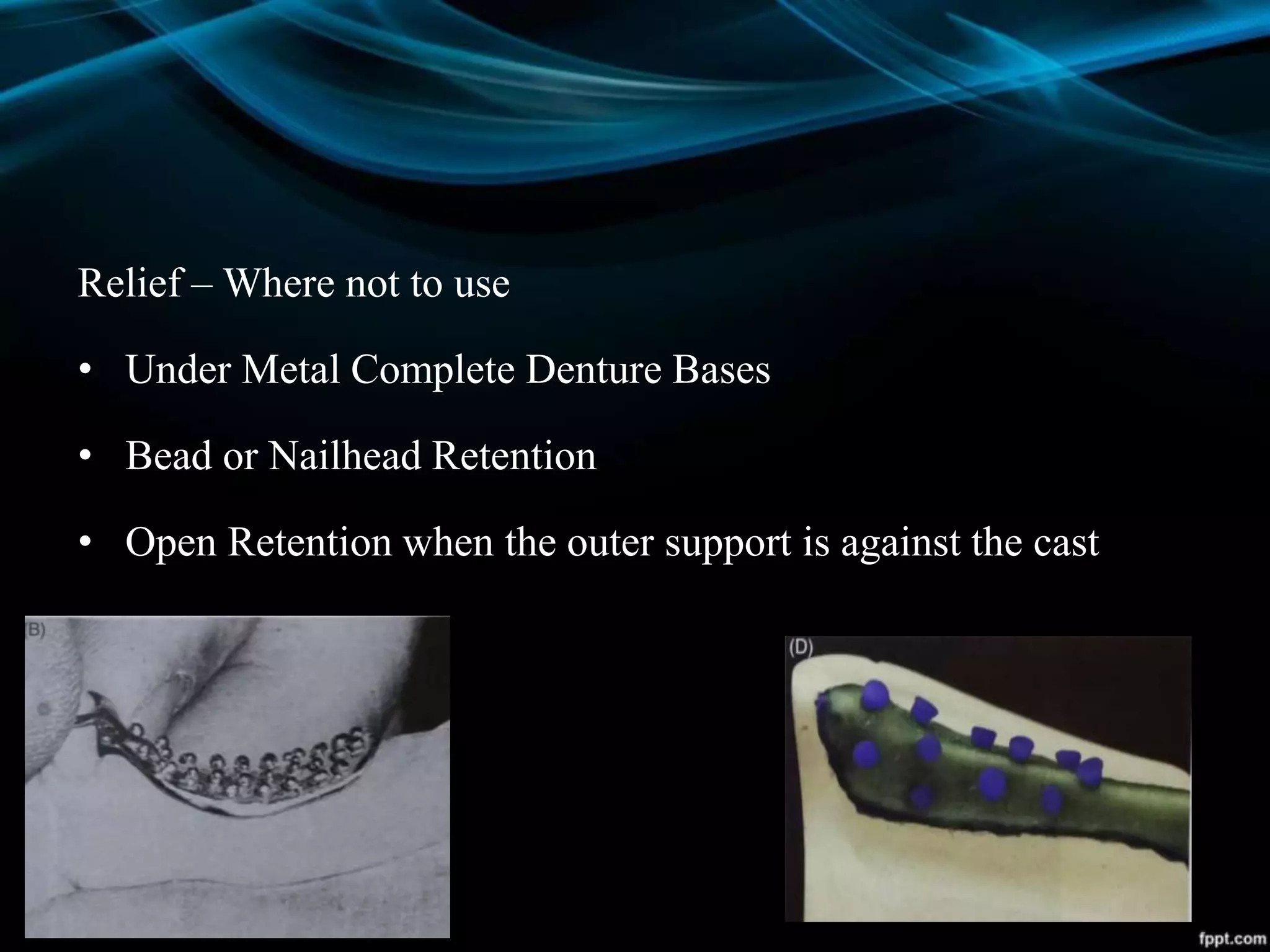 Relief – Where not to use
• Under Metal Complete Denture Bases
• Bead or Nailhead Retention
• Open Retention when the outer support is against the cast
 