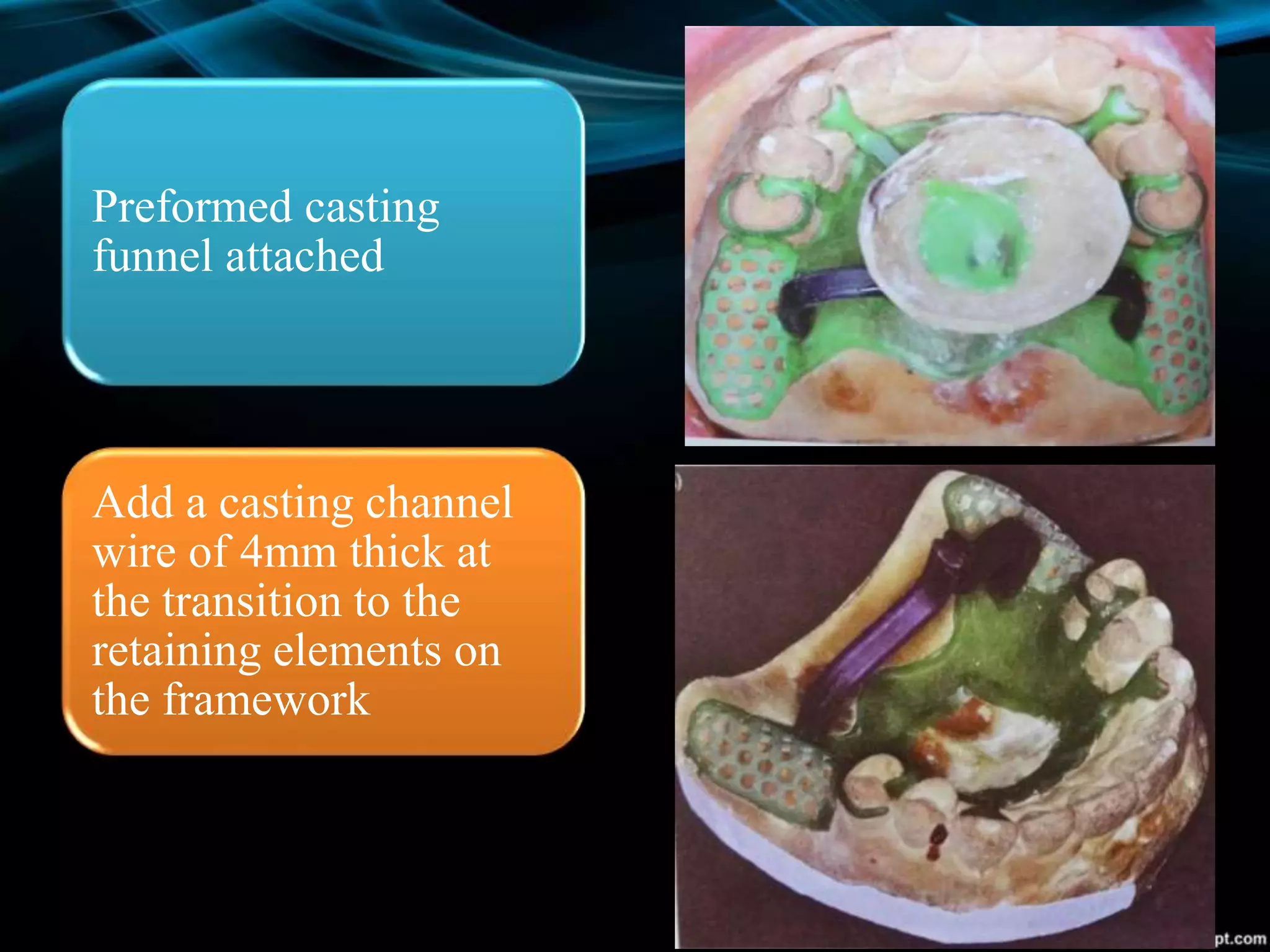 Preformed casting
funnel attached
Add a casting channel
wire of 4mm thick at
the transition to the
retaining elements on
the framework
 