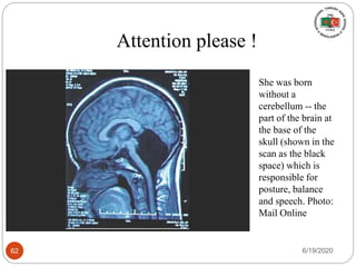 Attention please !
She was born
without a
cerebellum -- the
part of the brain at
the base of the
skull (shown in the
scan as the black
space) which is
responsible for
posture, balance
and speech. Photo:
Mail Online
6/19/202062
 
