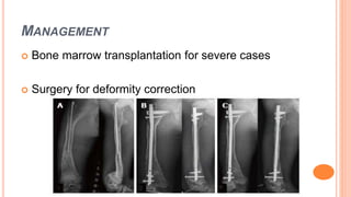MANAGEMENT
 Bone marrow transplantation for severe cases
 Surgery for deformity correction
 