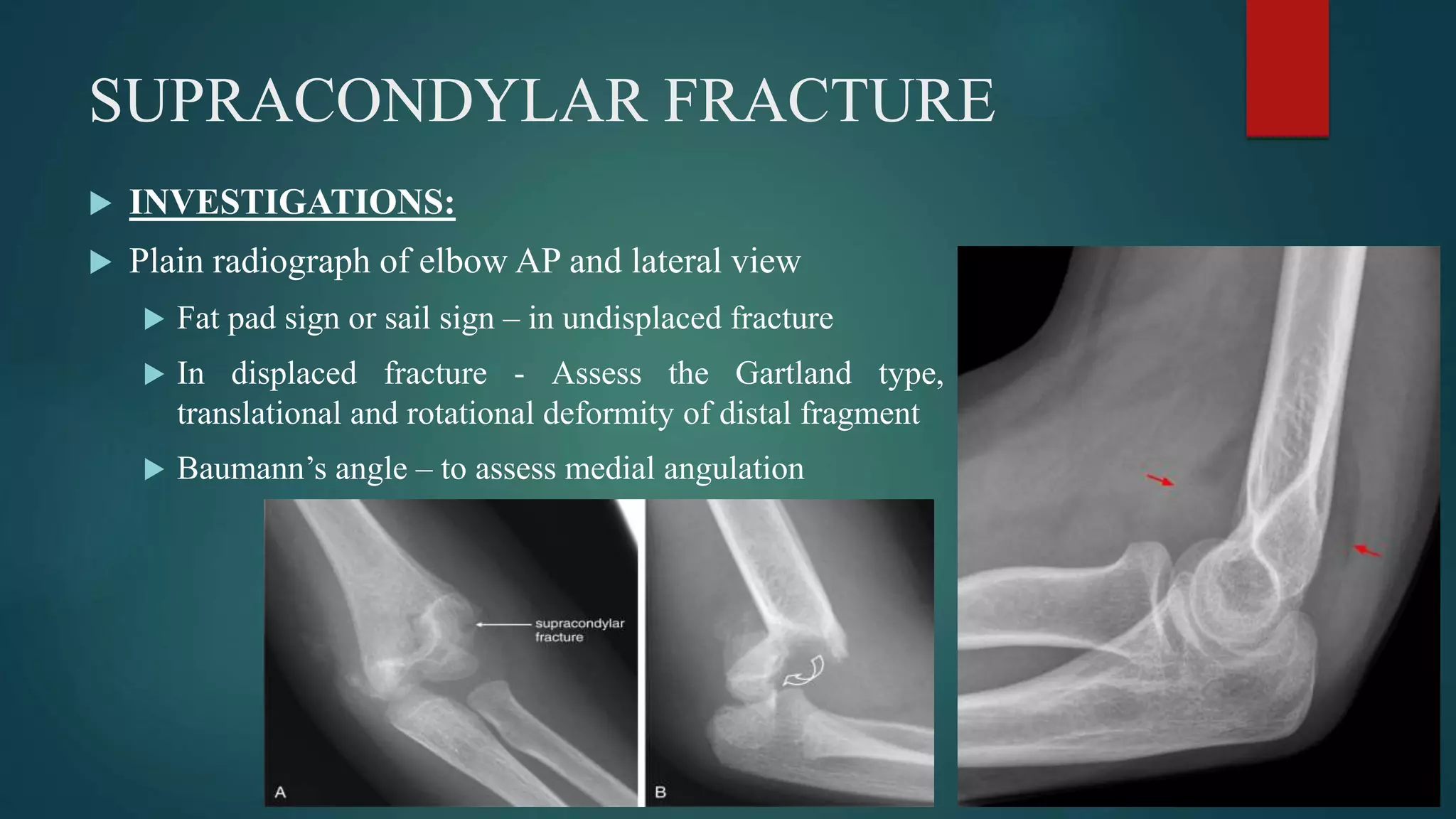 Supracondylar Fracture Of Humerus PPTX Supracondylar Fracture Of Humerus PPTX