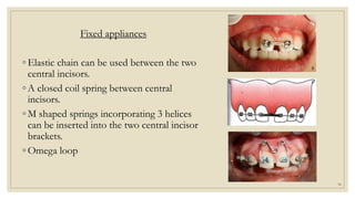 Fixed appliances
◦ Elastic chain can be used between the two
central incisors.
◦ A closed coil spring between central
incisors.
◦ M shaped springs incorporating 3 helices
can be inserted into the two central incisor
brackets.
◦ Omega loop
56
 