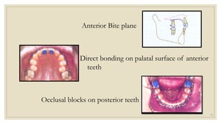 Anterior Bite plane
Direct bonding on palatal surface of anterior
teeth
Occlusal blocks on posterior teeth
70
 