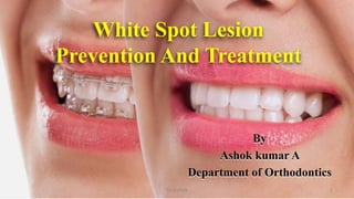 White Spot Lesion
Prevention And Treatment
By
Ashok kumar A
Department of Orthodontics
1Dr.Ashok
 