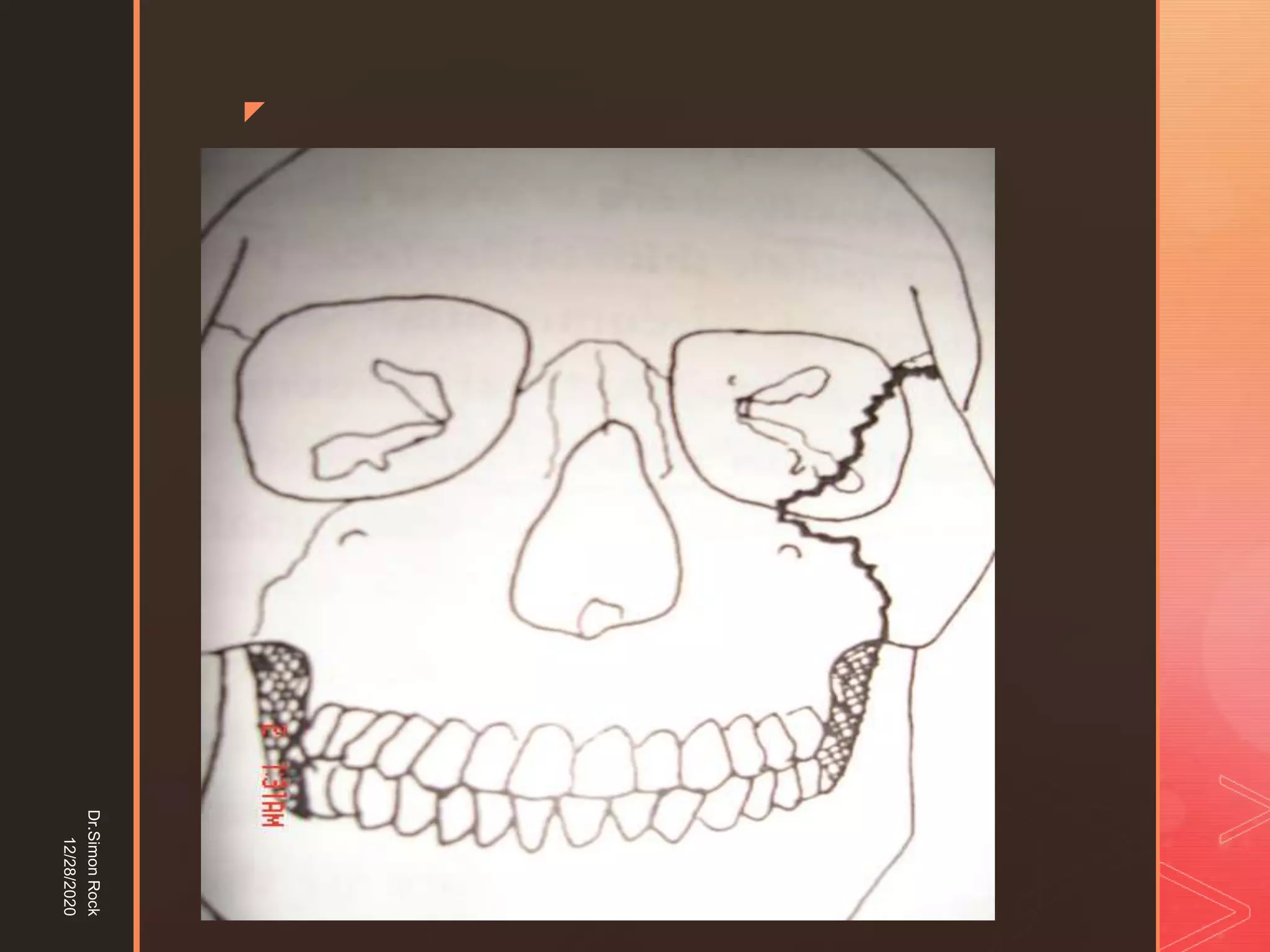 5. zygomatic fracture