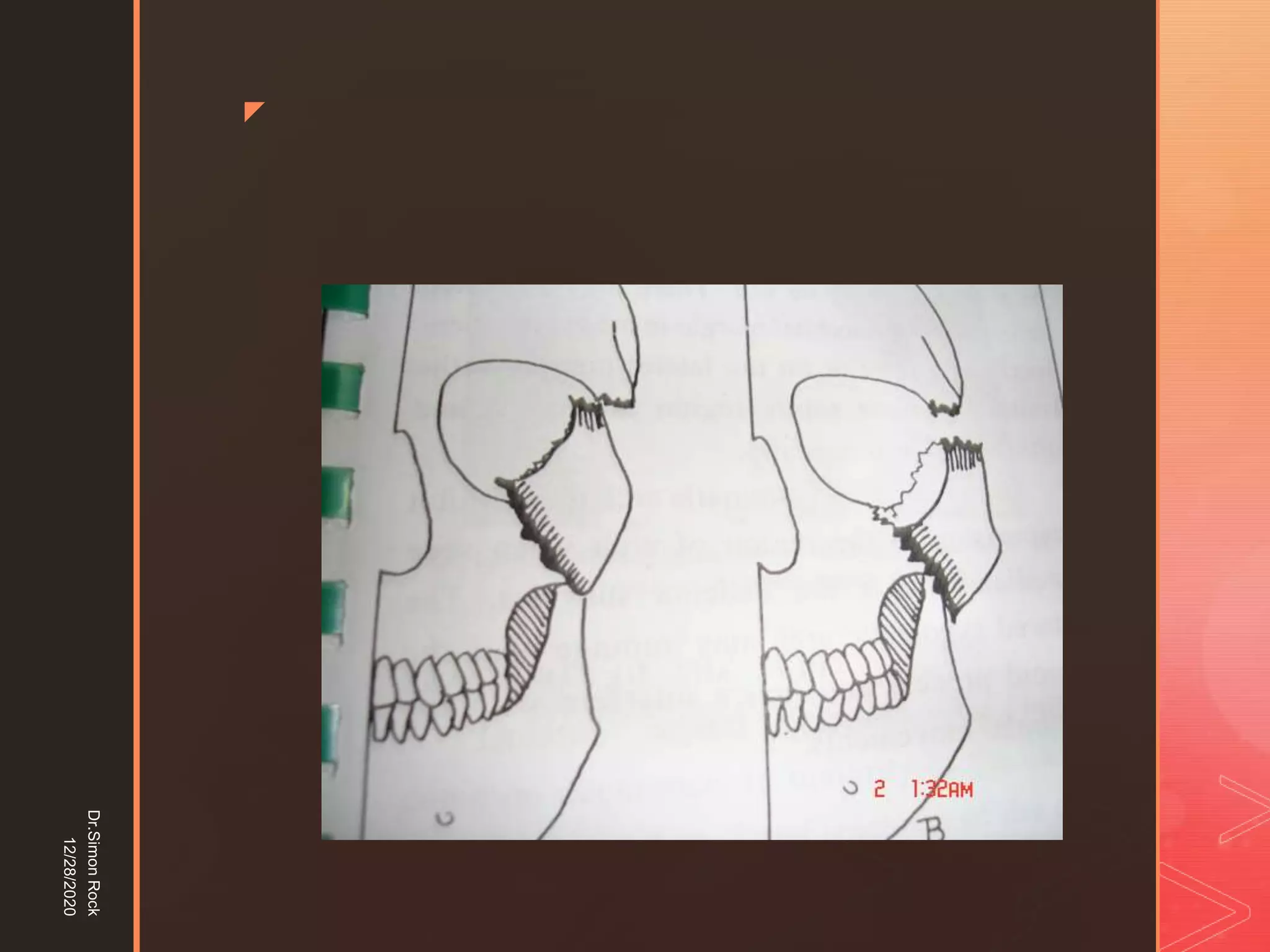 5. zygomatic fracture