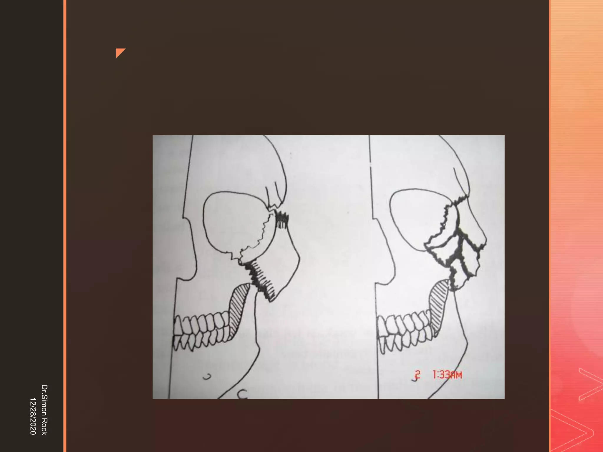 5. zygomatic fracture
