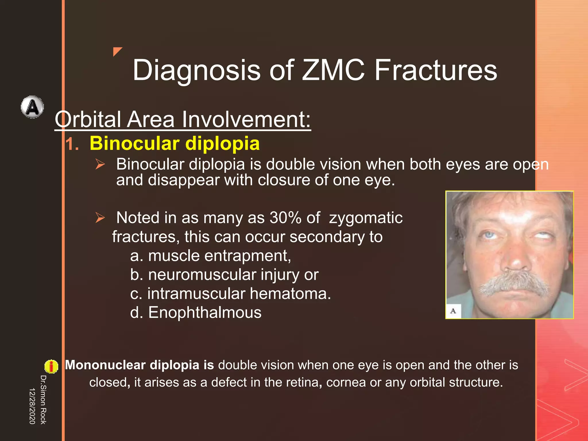 5. zygomatic fracture