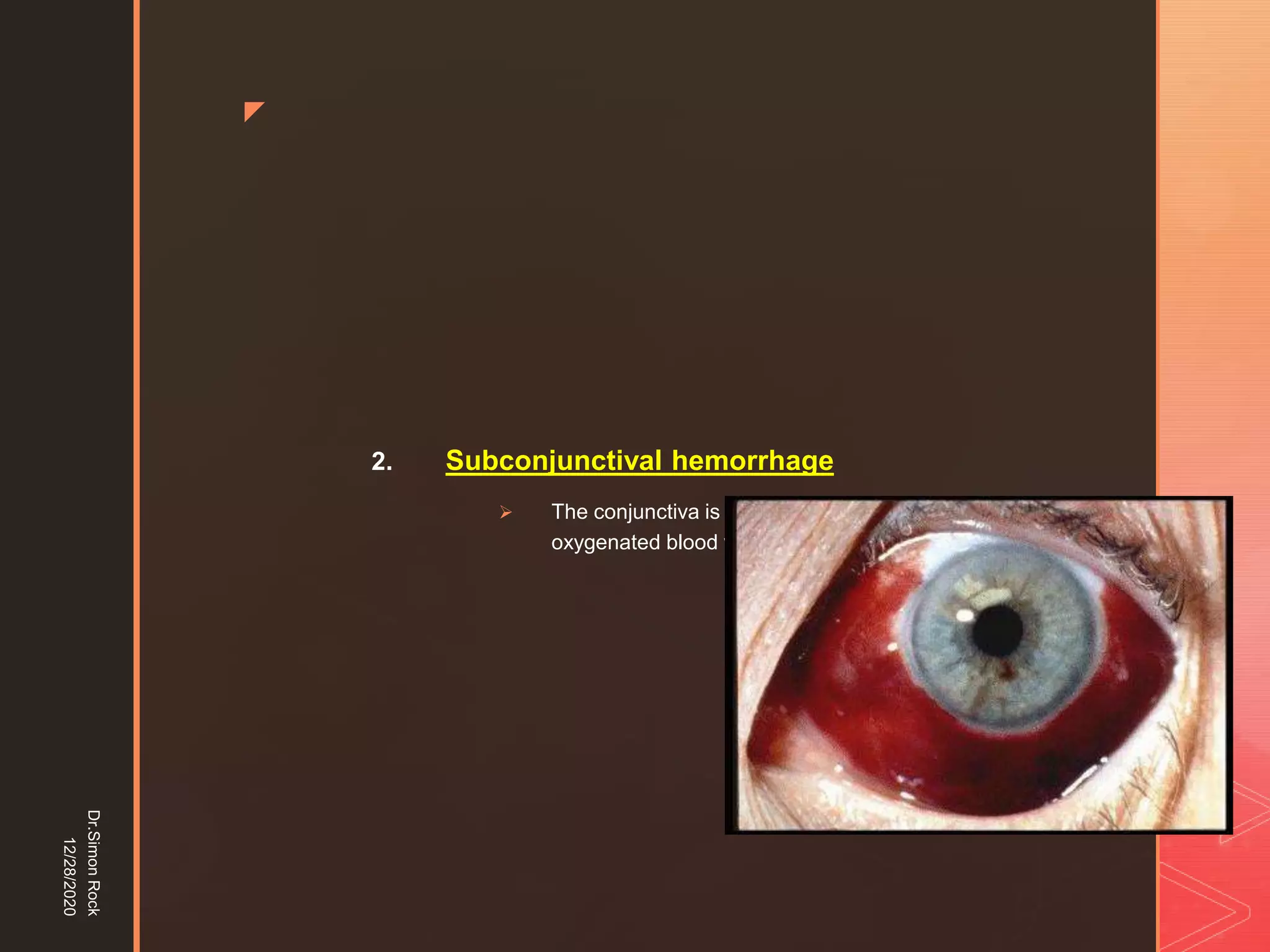 5. zygomatic fracture