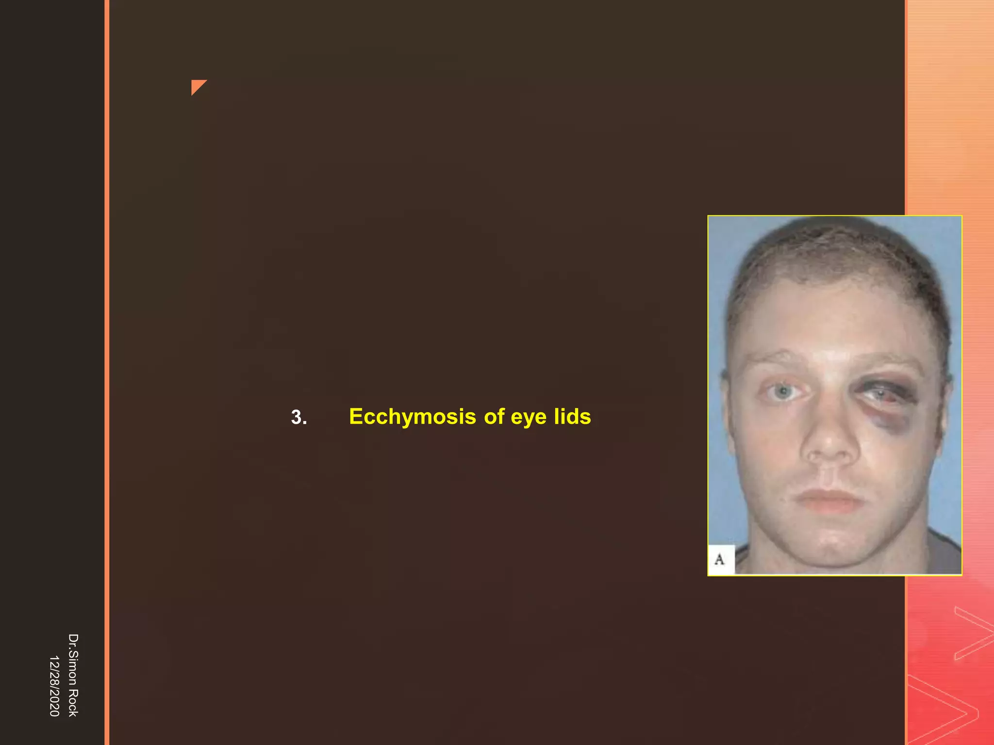 5. zygomatic fracture