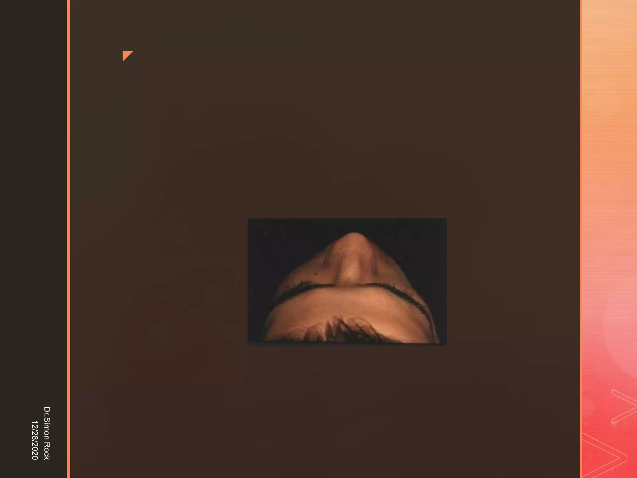 5. zygomatic fracture