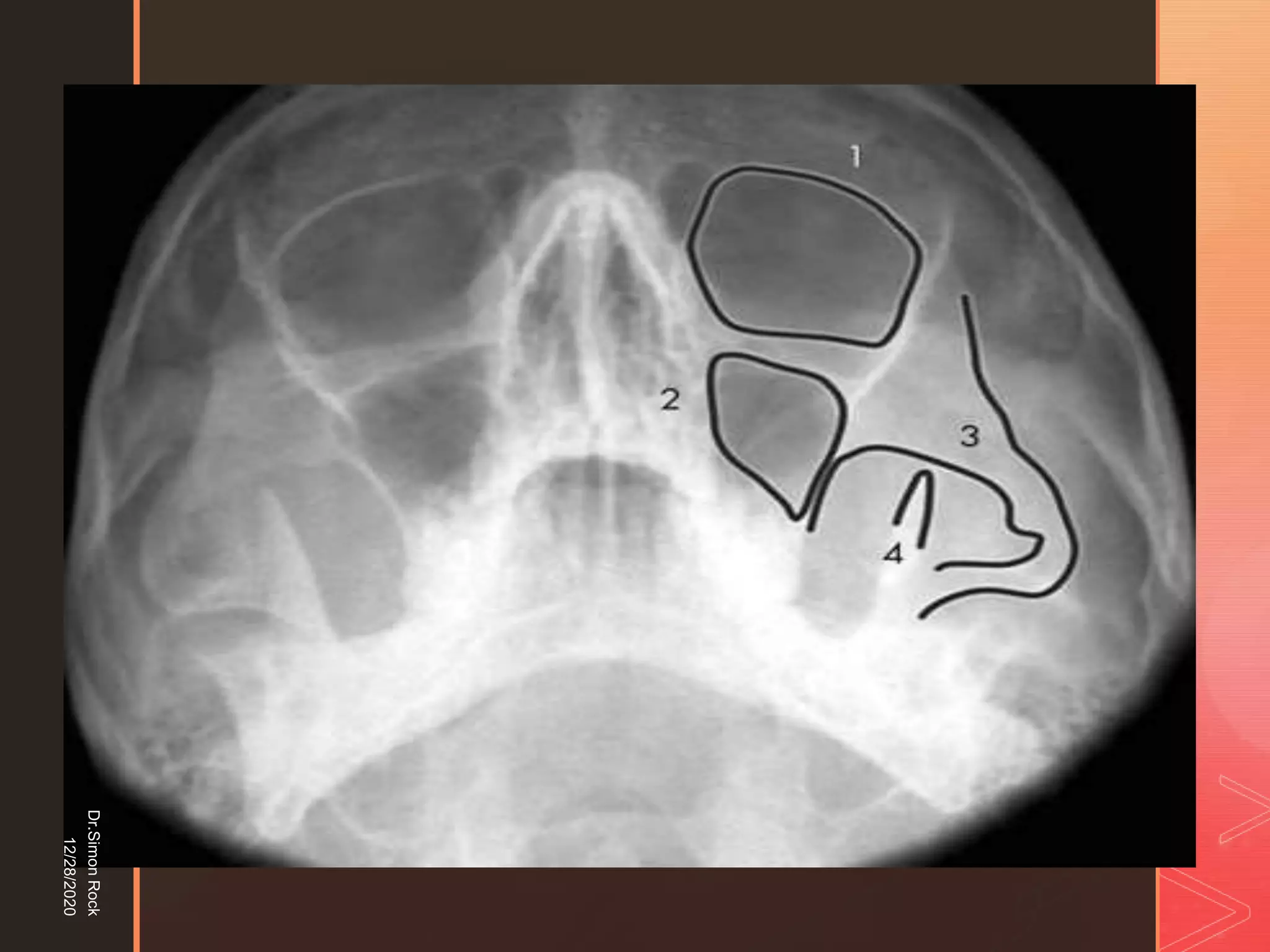 5. zygomatic fracture