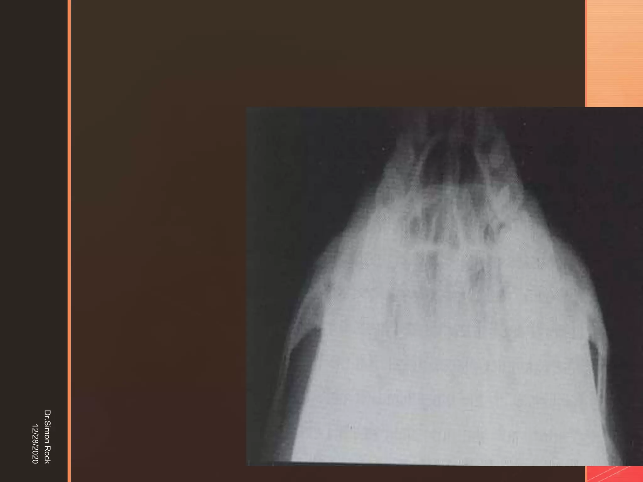 5. zygomatic fracture