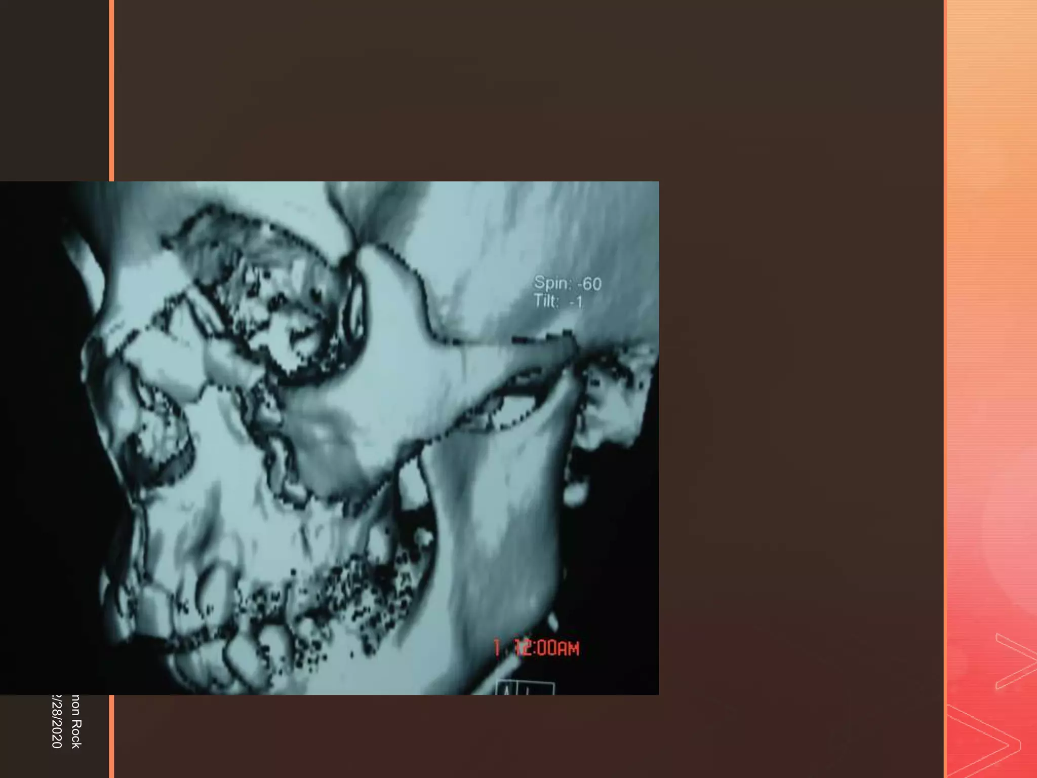 5. zygomatic fracture