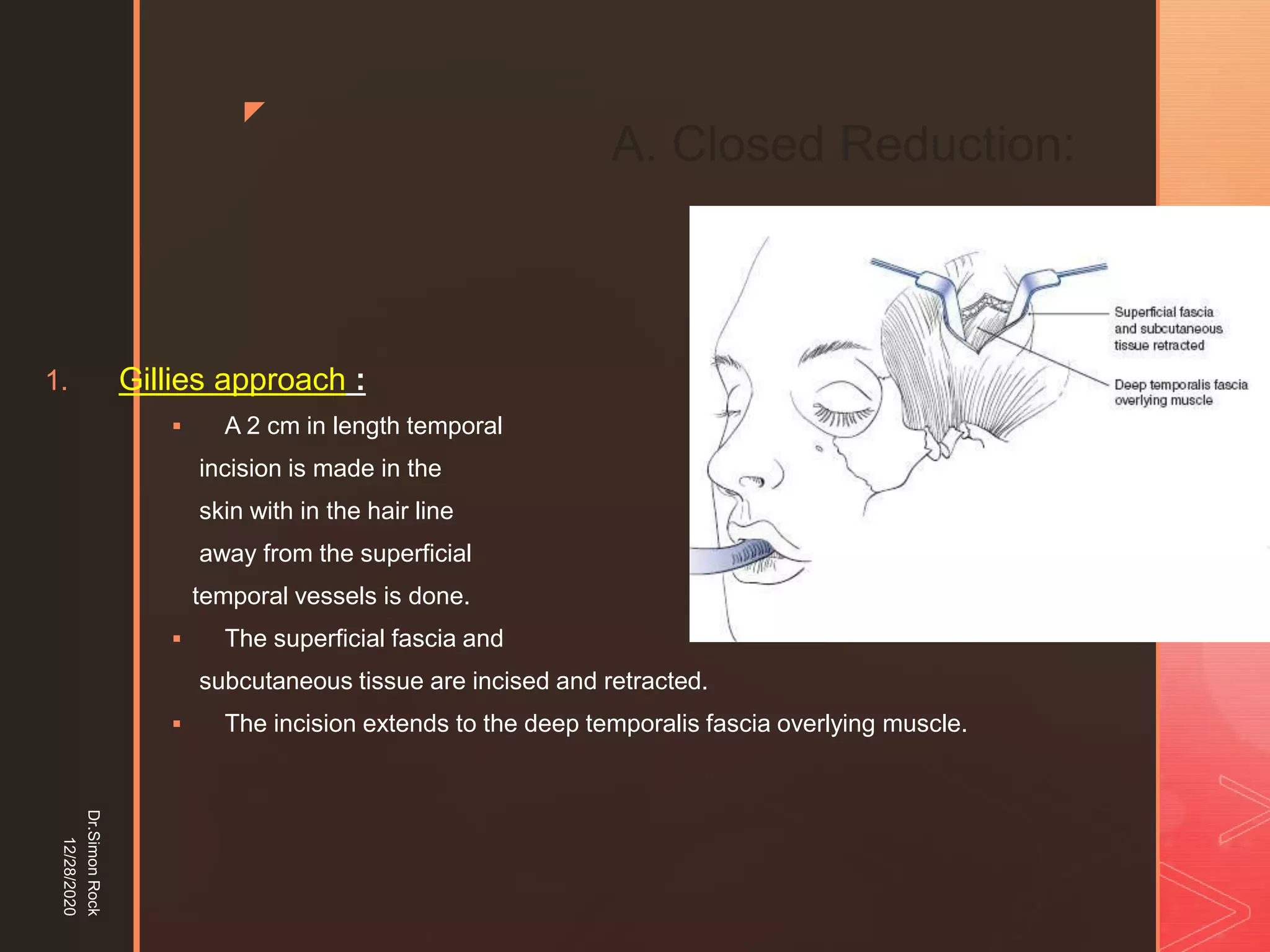 5. zygomatic fracture