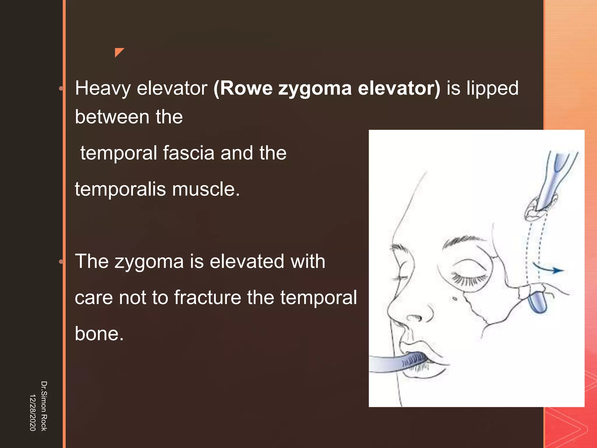 5. zygomatic fracture