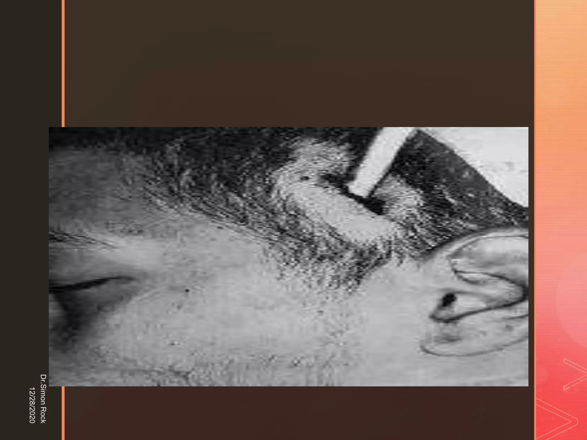 5. zygomatic fracture