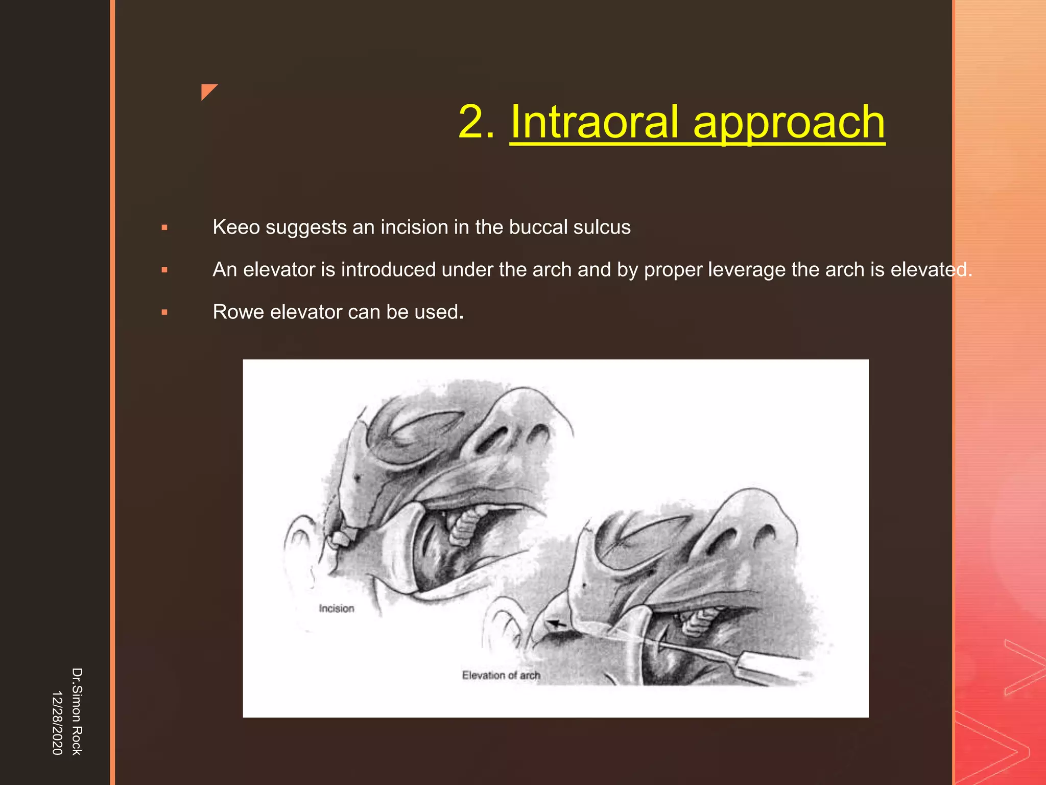 5. zygomatic fracture