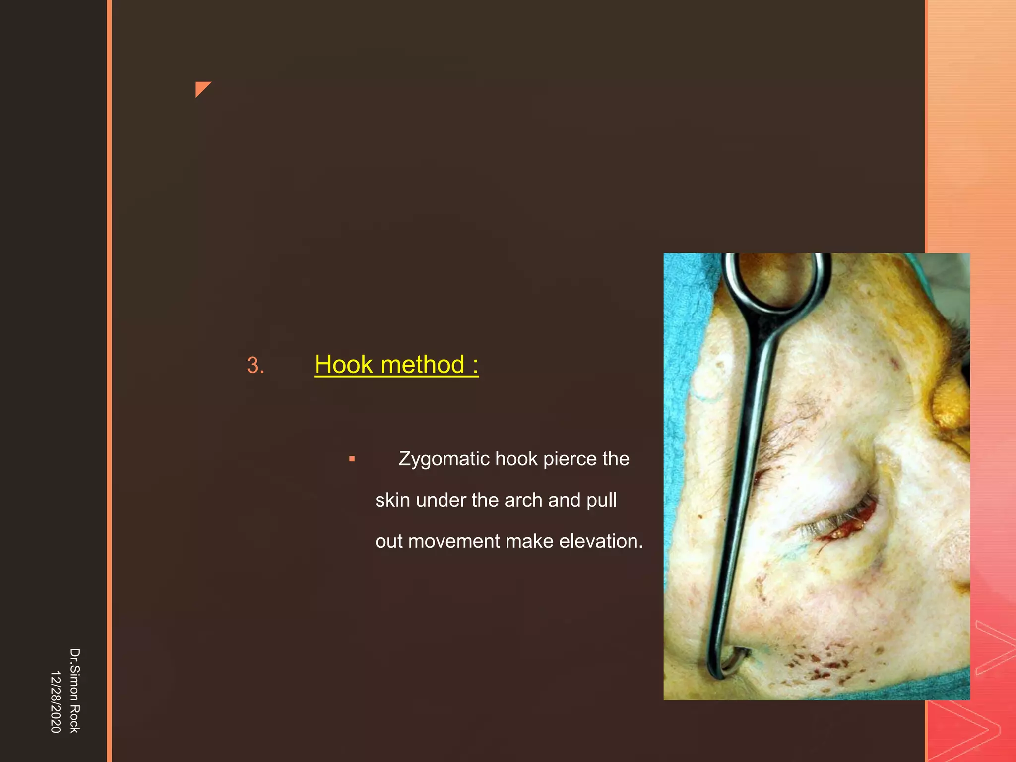 5. zygomatic fracture