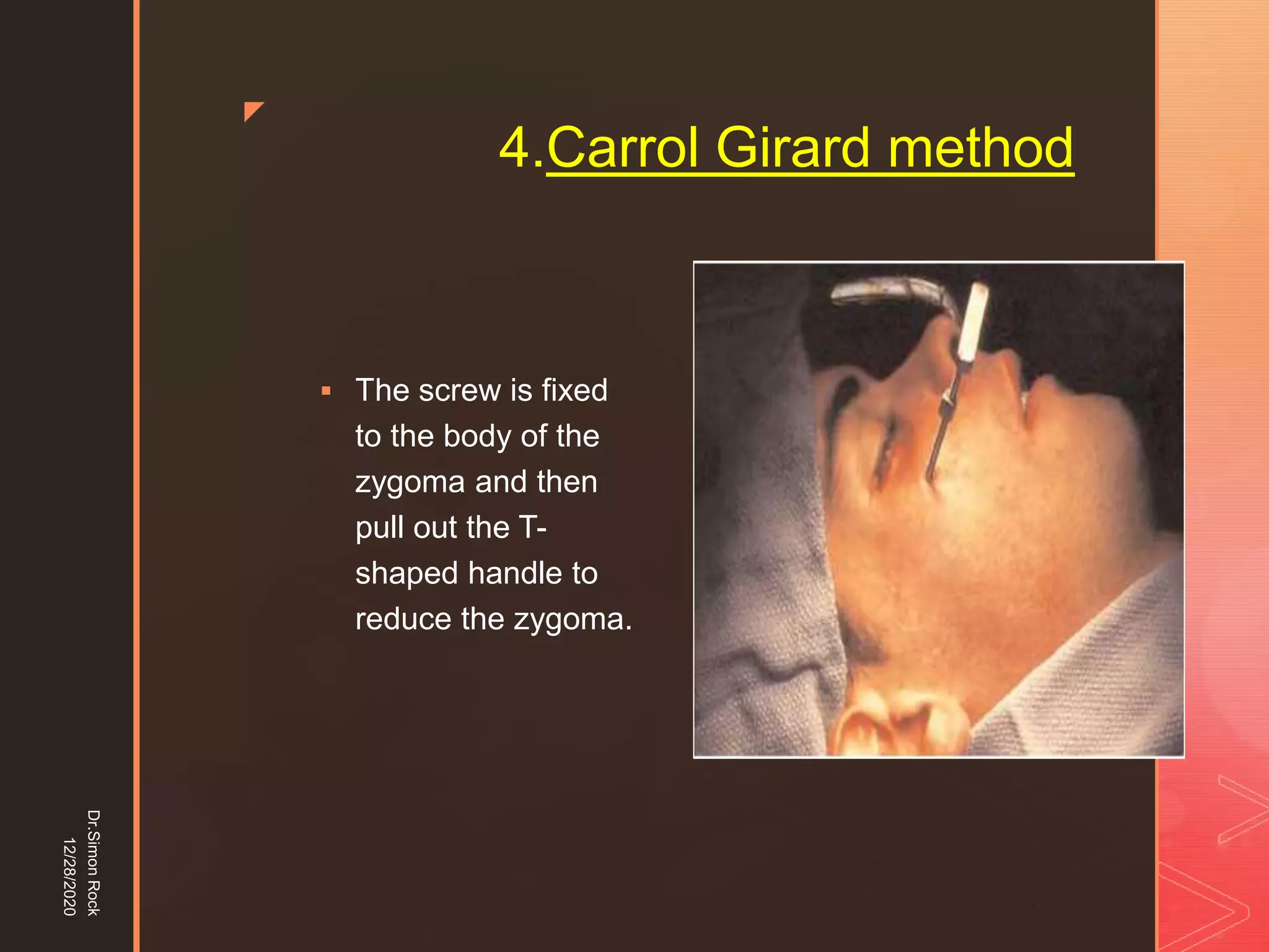 5. zygomatic fracture