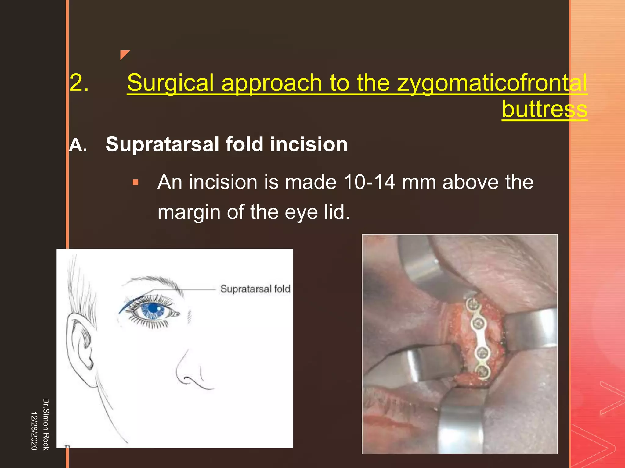 5. zygomatic fracture