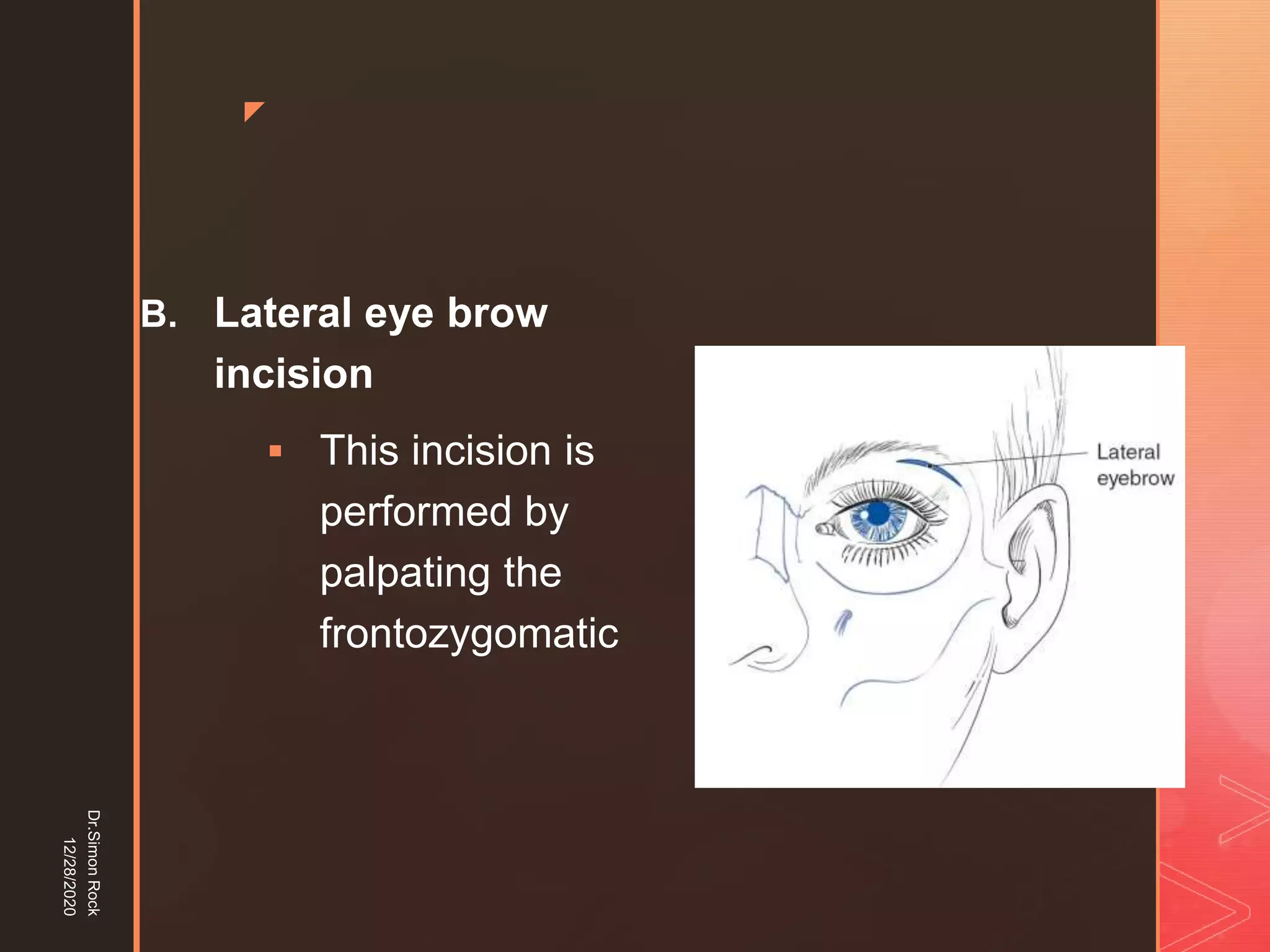 5. zygomatic fracture