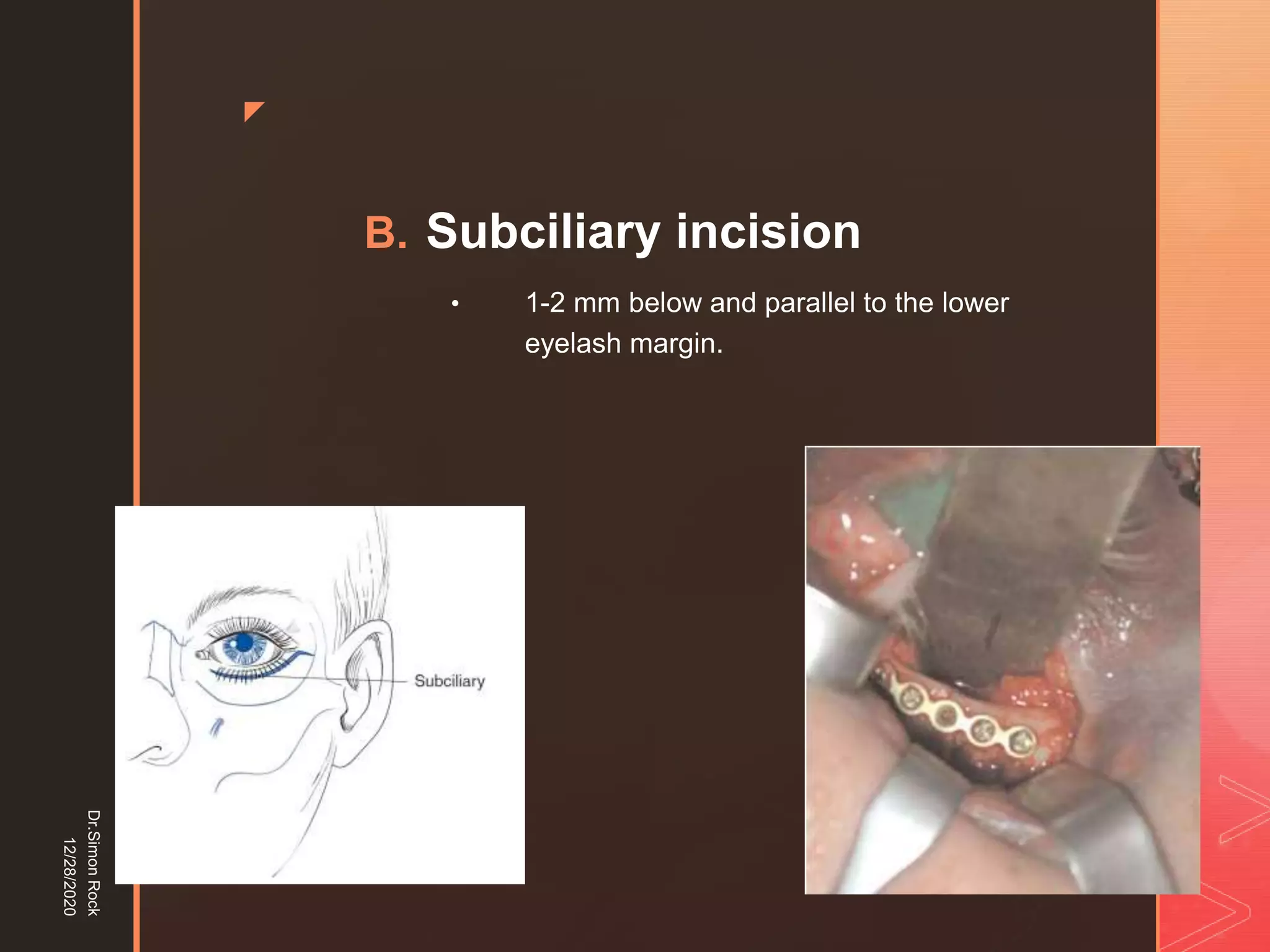 5. zygomatic fracture