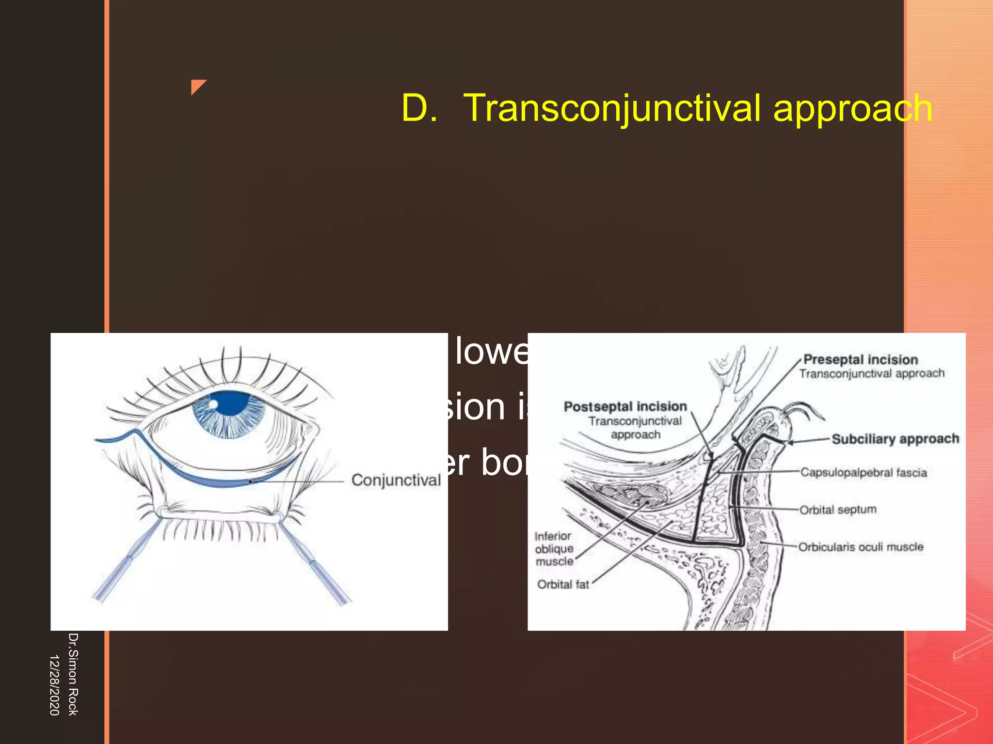 5. zygomatic fracture