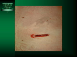 INJURY Forensic Medicine by Sir Zia Ashraf | PPT