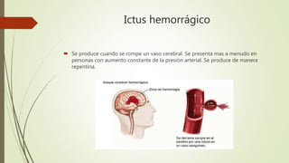 Ictus hemorrágico
 Se produce cuando se rompe un vaso cerebral. Se presenta mas a menudo en
personas con aumento constante de la presión arterial. Se produce de manera
repentina.
 