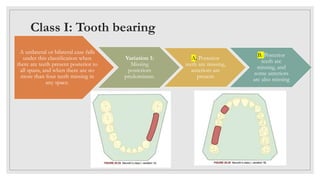 Tooth Case Classification classification of partially edentulous arches | PPTX